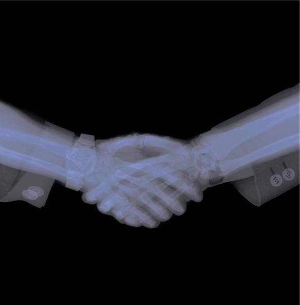 Ronny & Renzo - Broken Fingers